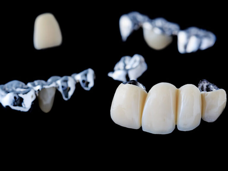 dental crowns