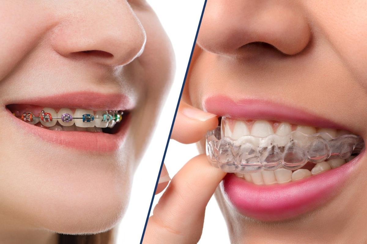 invisalign or braces which treatment is right for you
