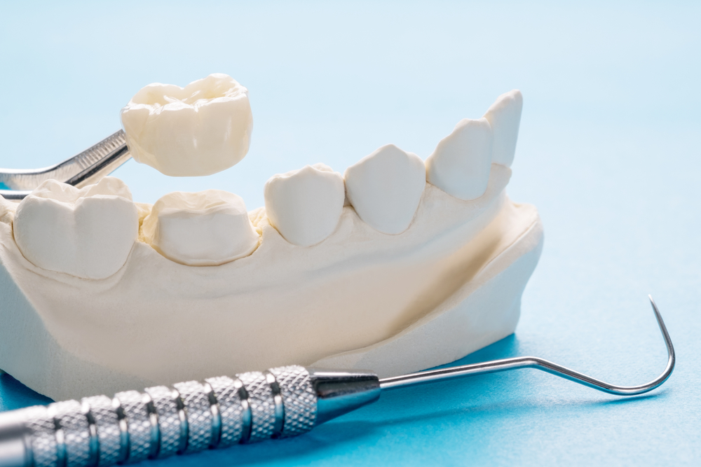 When Do You Need a Dental Crown? Signs and Treatment Options