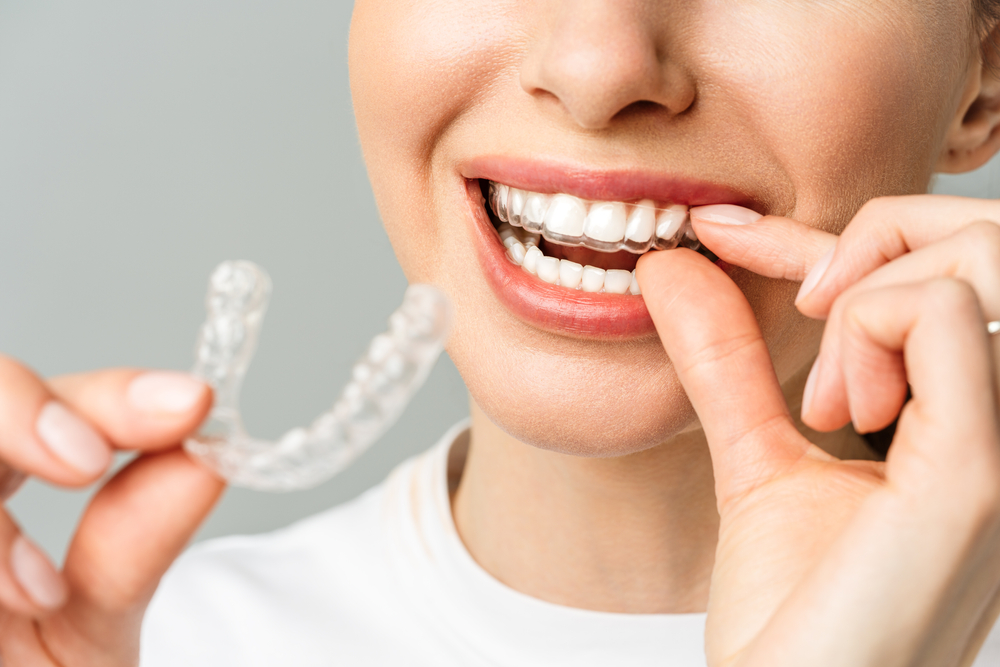 What Happens After Invisalign, Retainers, Results & Long-Term Care