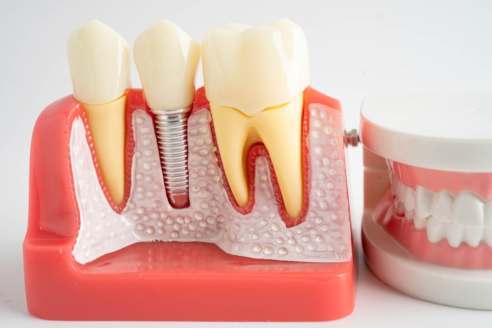 How Dental Implants Improve Chewing, confidence and long term health