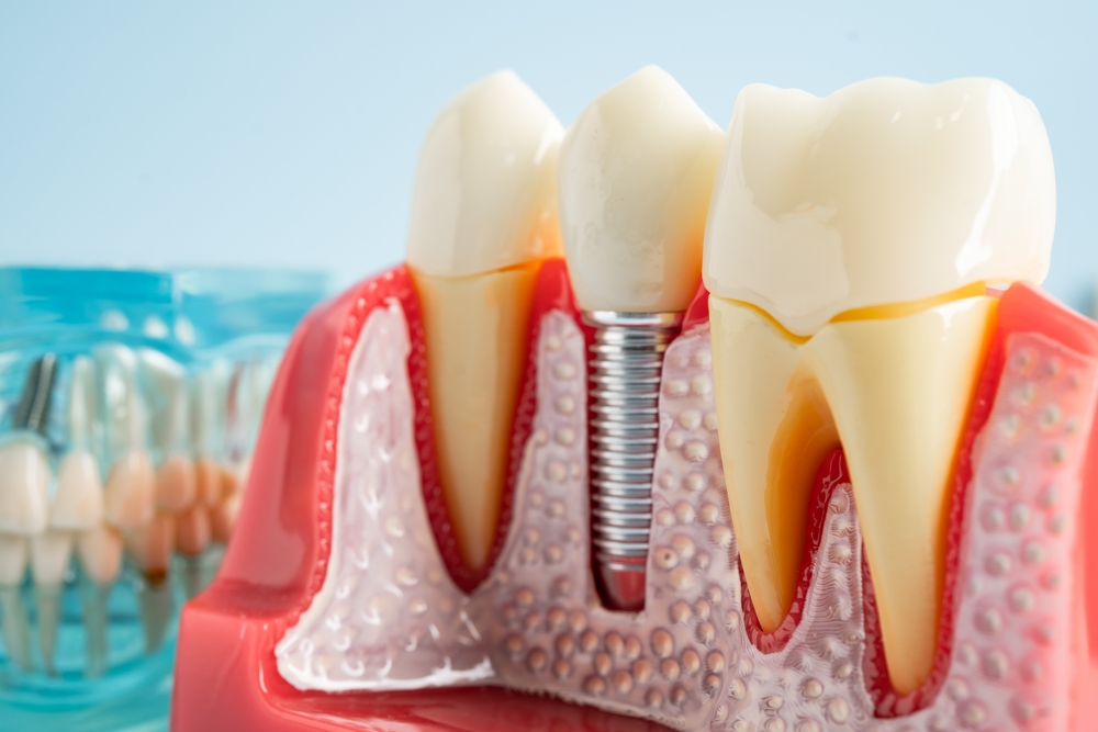 what are dental implants, types of dental implants and how much do they cost