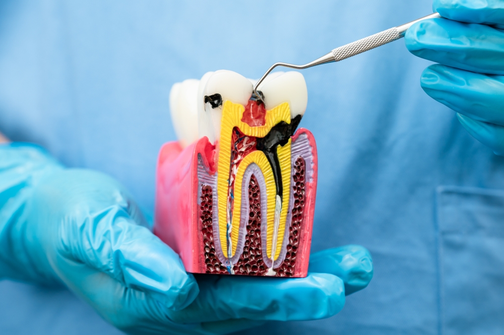 do you need a crown after a root canal a complete guide to root canal treatment for infected teeth