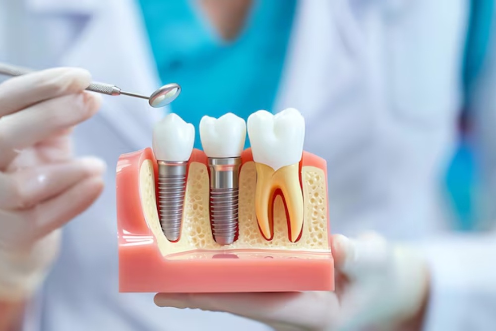 dental implants compared to natural tooth
